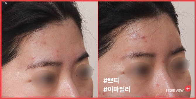 엣지 성형외과&피부과 이마필러 BEFORE / AFTER