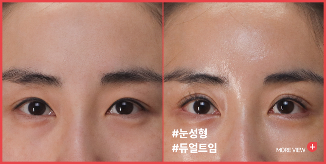 엣지 성형외과&피부과 눈성형 BEFORE / AFTER