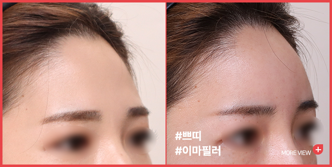 엣지 성형외과&피부과 이마필러 BEFORE / AFTER