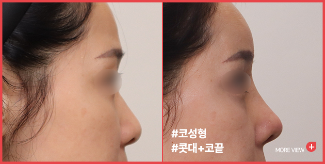 엣지성형외과&피부과_코성형 BEFORE/AFTER