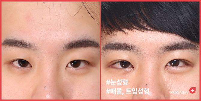 엣지 성형외과&피부과 눈 성형 BEFORE / AFTER