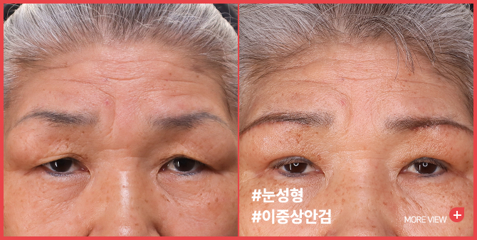 엣지 성형외과&피부과 이중상안검 BEFORE / AFTER