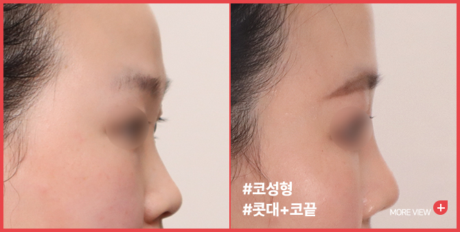엣지 성형외과&피부과 코 성형 BEFORE / AFTER
