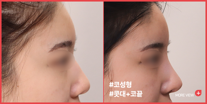 엣지 성형외과&피부과 코 성형 BEFORE / AFTER