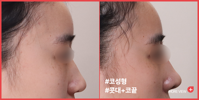 엣지 성형외과&피부과 코성형 BEFORE / AFTER
