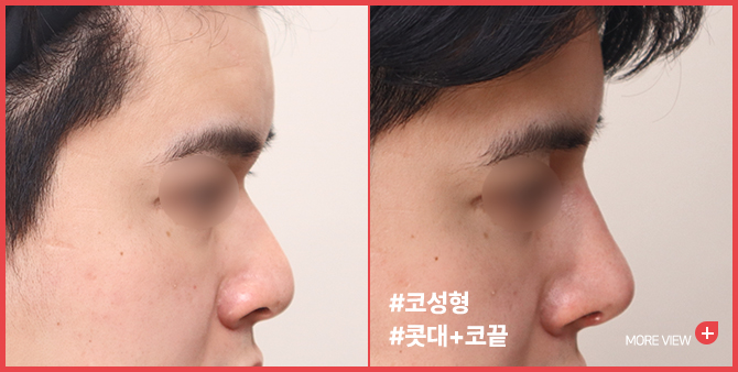 엣지 성형외과&피부과 코성형 BEFORE / AFTER