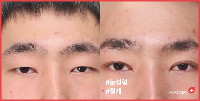 엣지 성형외과&피부과 쌍꺼풀 BEFORE / AFTER