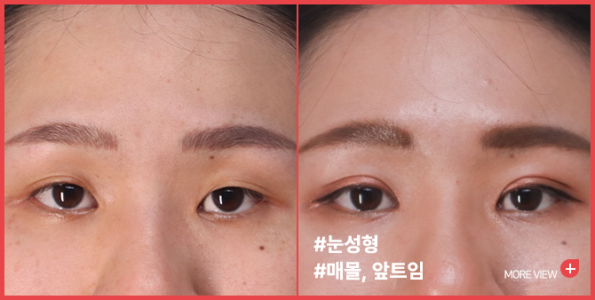 엣지 성형외과&피부과 눈성형 BEFORE / AFTER