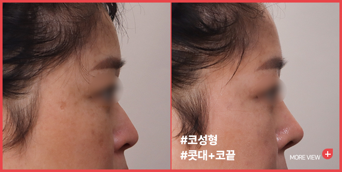 엣지 성형외과&피부과 코성형 BEFORE / AFTER