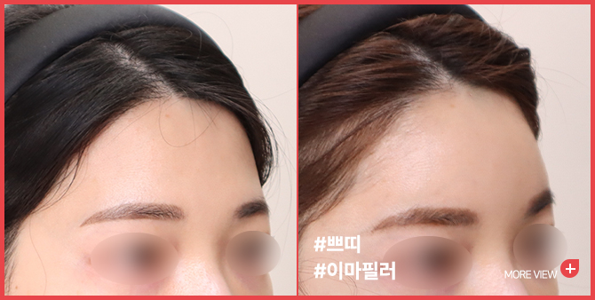 엣지 성형외과&피부과 이마필러 BEFORE / AFTER