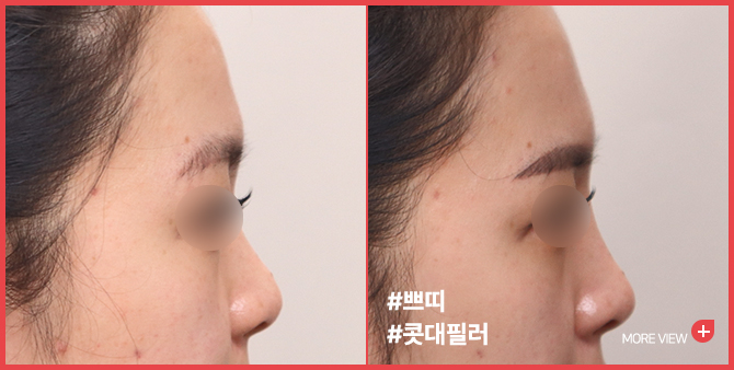 엣지 성형외과&피부과 콧대필러 BEFORE / AFTER