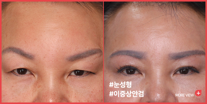 엣지 성형외과&피부과 이중상안검 BEFORE / AFTER