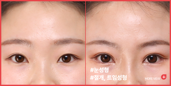 엣지 성형외과&피부과 눈성형 BEFORE / AFTER