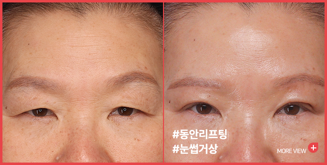 엣지 성형외과&피부과 눈썹거상 BEFORE / AFTER