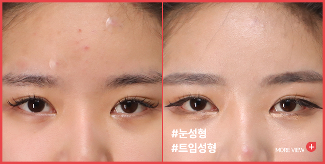 엣지 성형외과&피부과 눈 성형 BEFORE / AFTER