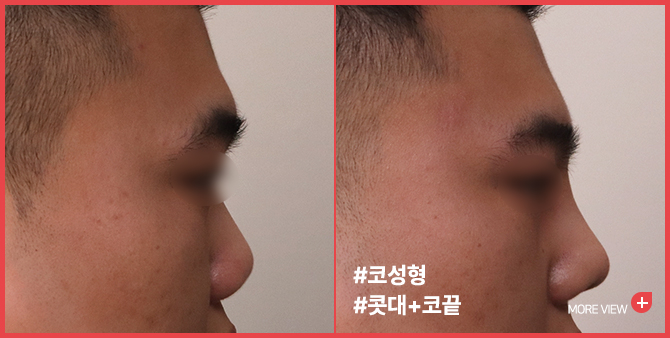 엣지 성형외과&피부과 코성형 BEFORE / AFTER