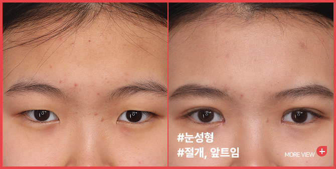 엣지 성형외과&피부과 눈성형 BEFORE / AFTER