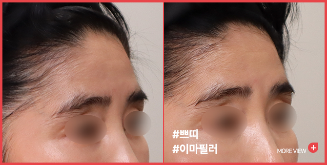 엣지 성형외과&피부과 이마필러 BEFORE / AFTER