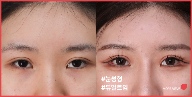 엣지 성형외과&피부과 듀얼트임 BEFORE / AFTER