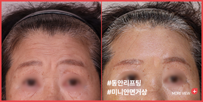 엣지 성형외과&피부과 미니거상 BEFORE / AFTER