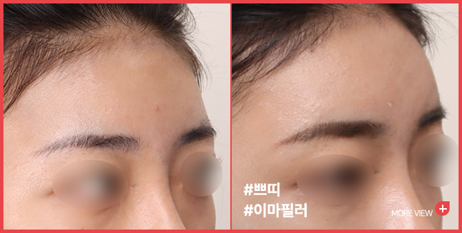 엣지 성형외과&피부과 이마필러 BEFORE / AFTER