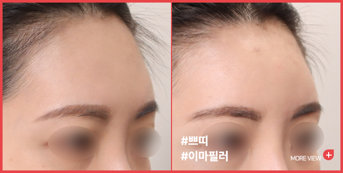 엣지 성형외과&피부과 이마필러 BEFORE / AFTER