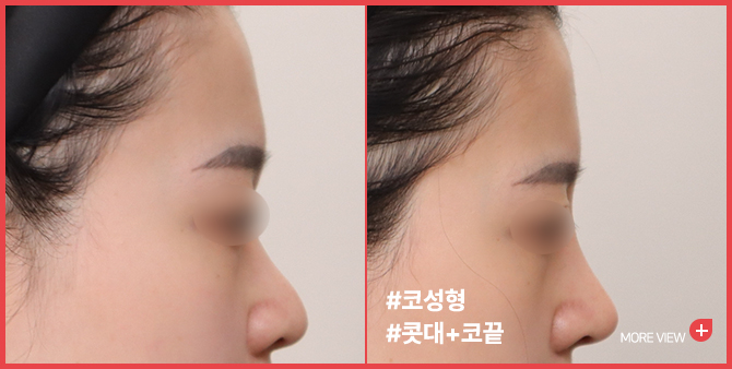 엣지 성형외과&피부과 코 성형 BEFORE / AFTER