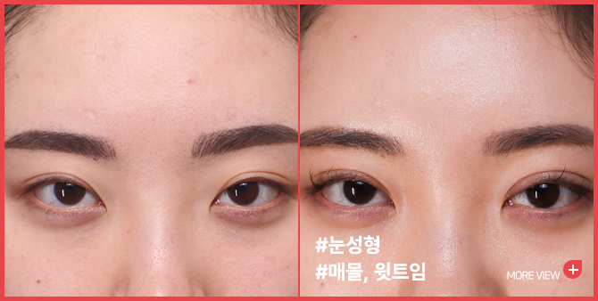 엣지 성형외과&피부과 눈성형 BEFORE / AFTER