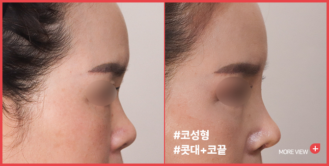 엣지 성형외과&피부과 코성형 BEFORE / AFTER