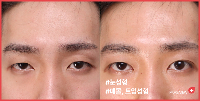 엣지 성형외과&피부과 눈 성형 BEFORE / AFTER