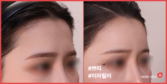 엣지 성형외과&피부과 이마필러 BEFORE / AFTER