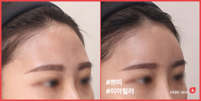 엣지 성형외과&피부과 이마필러 BEFORE / AFTER