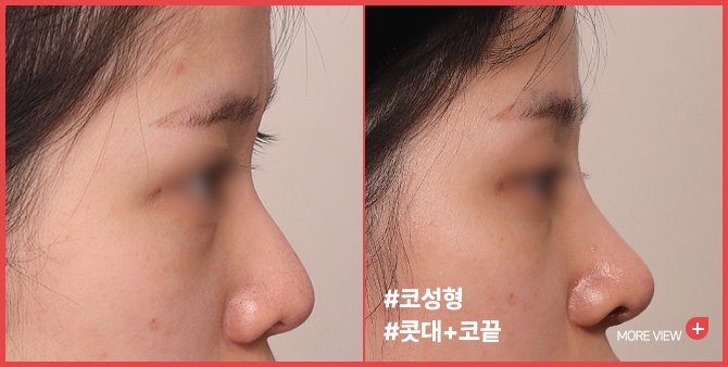 엣지 성형외과&피부과 코성형 BEFORE / AFTER