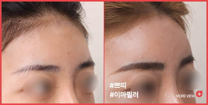 엣지 성형외과&피부과 이마필러 BEFORE / AFTER