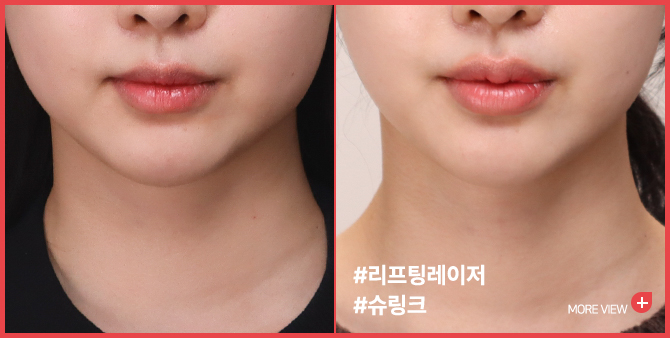 엣지 성형외과&피부과 슈링크 BEFORE / AFTER