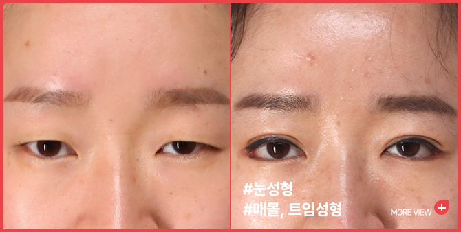 엣지 성형외과&피부과 눈 성형 BEFORE / AFTER