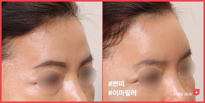 엣지 성형외과&피부과 이마필러 BEFORE / AFTER