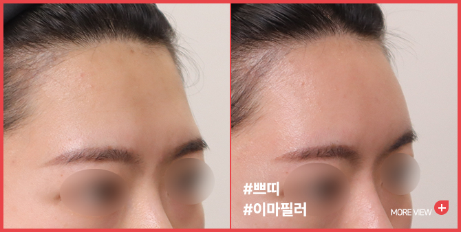 엣지 성형외과&피부과 이마필러 BEFORE / AFTER