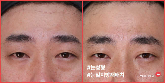 엣지 성형외과&피부과 눈성형 BEFORE / AFTER