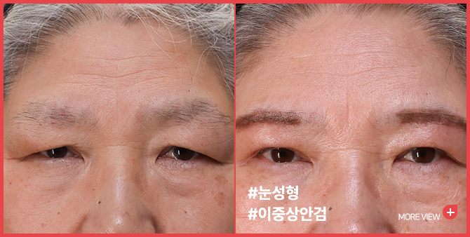 엣지 성형외과&피부과 눈성형 BEFORE / AFTER