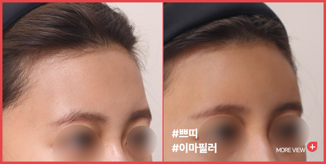 엣지 성형외과&피부과 이마필러 BEFORE / AFTER
