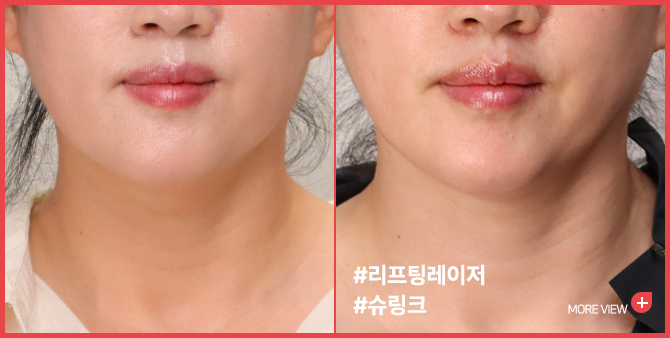 엣지 성형외과&피부과 슈링크 BEFORE / AFTER