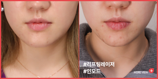 엣지 성형외과&피부과 리프팅 BEFORE / AFTER