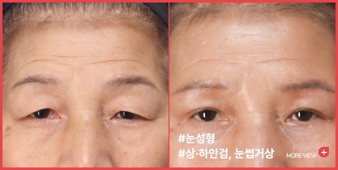 엣지 성형외과&피부과 이중상안검 BEFORE / AFTER