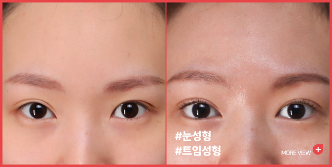 엣지 성형외과&피부과 눈성형 BEFORE / AFTER