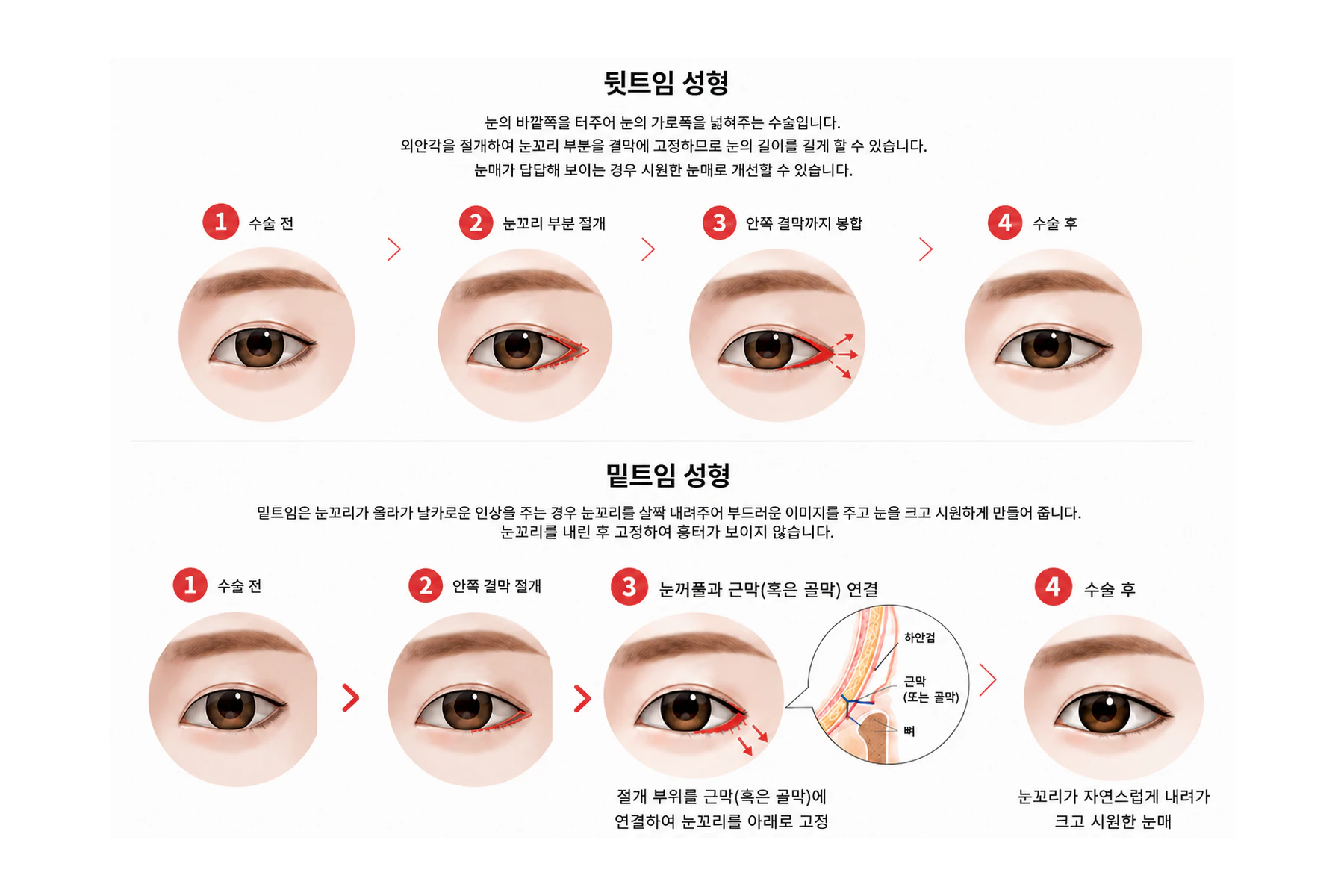 뒷트임 성형과 밑트임 성형의 단계별 수술 과정 일러스트