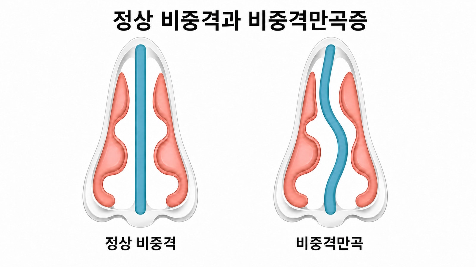 정상 비중격과 비중격만곡증을 비교한 의료 일러스트