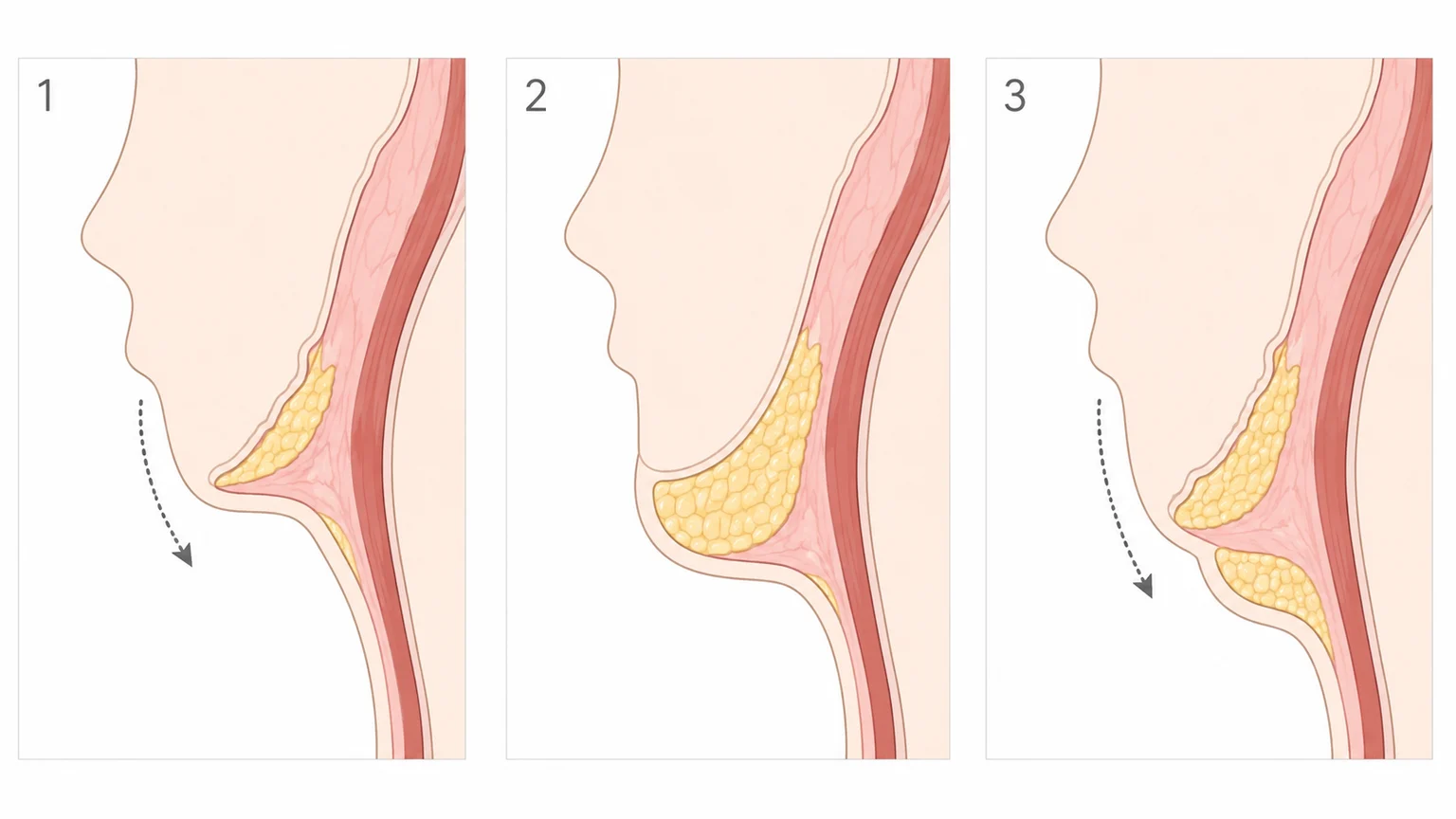 턱선이 무너지는 원인을 조직 처짐 중심, 지방량 중심, 복합형으로 나눈 단면 예시 이미지