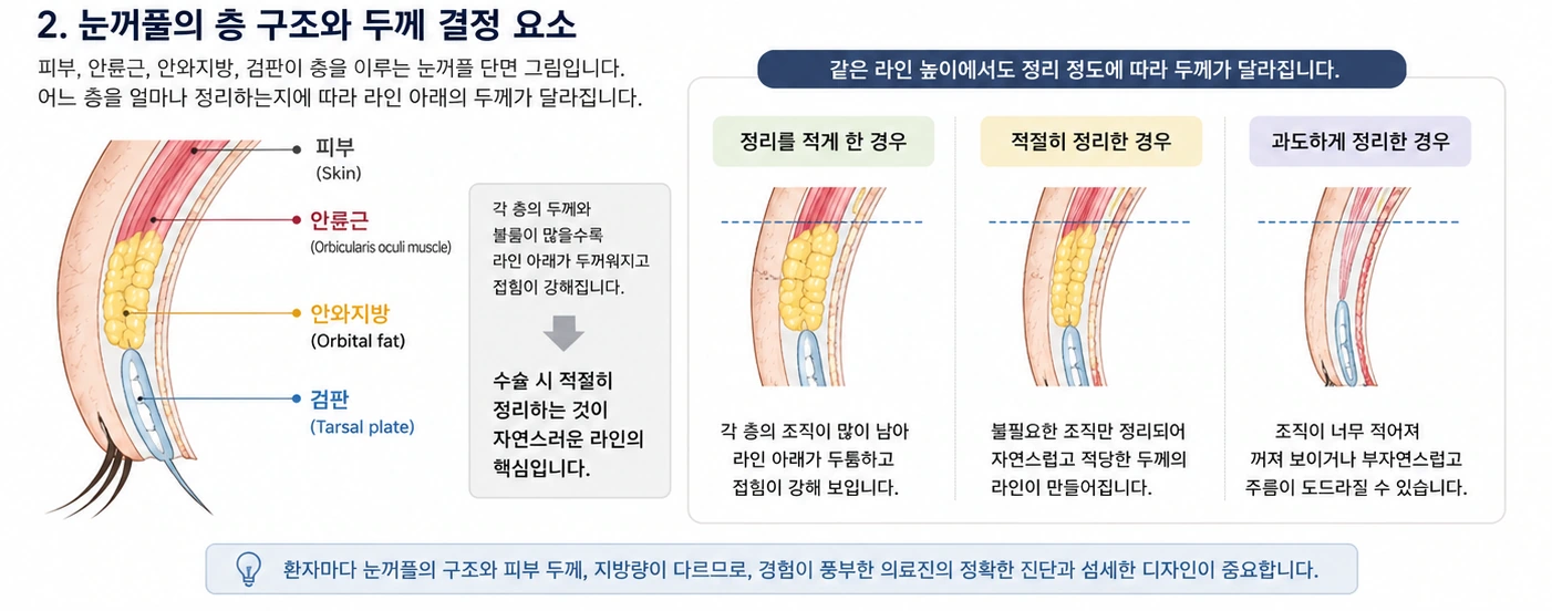 피부·안륜근·안와지방·검판의 층 구조와 정리 정도에 따른 라인 아래 두께 차이