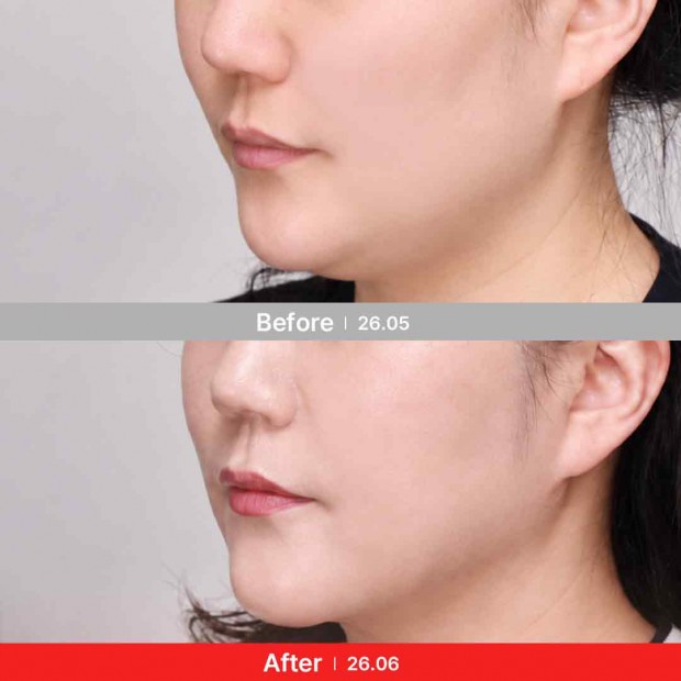 엣지 성형외과&피부과 리프팅 BEFORE / AFTER 전후 비교 정면